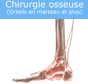 chirurgie-osseuse