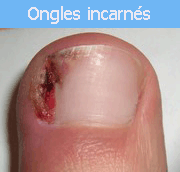 ongles-incarnes